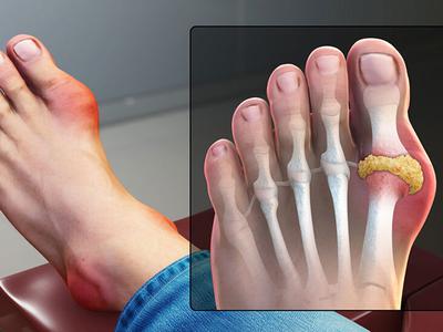 Bệnh gút (gout ) là gì? Nguyên nhân, triệu chứng và cách phòng tránh