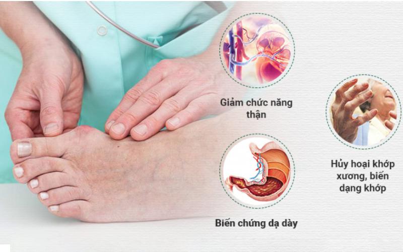 Bệnh Gút (Gout ) Là Gì? Nguyên Nhân, Triệu Chứng Và Cách Phòng Tránh