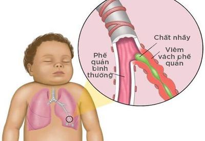 Bệnh hen phế quản ở trẻ em có nguy hiểm không?