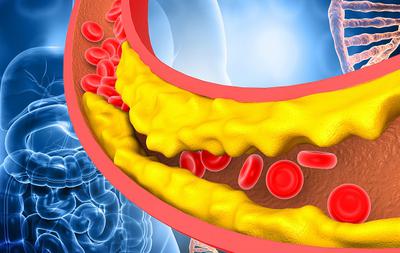 Chỉ Số LDL Cholesterol Trong Máu Và Những Điều Cần Biết Về Nó