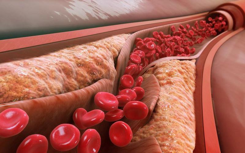 Chỉ Số LDL Cholesterol Trong Máu Và Những Điều Cần Biết Về Nó