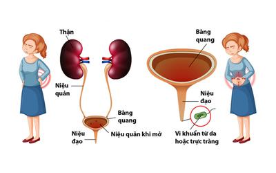 Viêm Đường Tiết Niệu Là Gì? Viêm Đường Tiết Niệu Có Tự Khỏi Không?