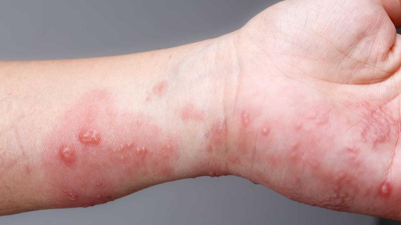 Các Cách Trị Ghẻ Ngứa Tại Nhà An Toàn Hiệu Quả