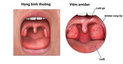 Những Lưu Ý Sau Khi Cắt Amidan Để Cơ Thể Nhanh Hồi Phục