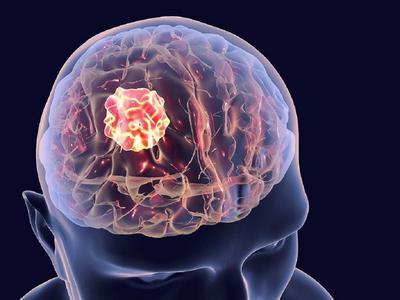 Dấu Hiệu Và Cách Chẩn Đoán Bệnh U Não Nguy Hiểm