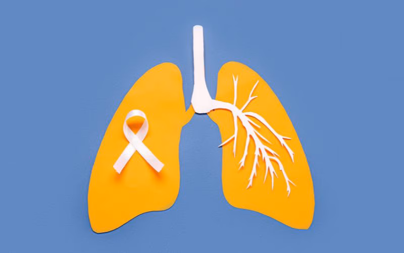 Ung thư phổi: Các nguyên nhân, triệu chứng, chẩn đoán và cách điều trị hiệu quả