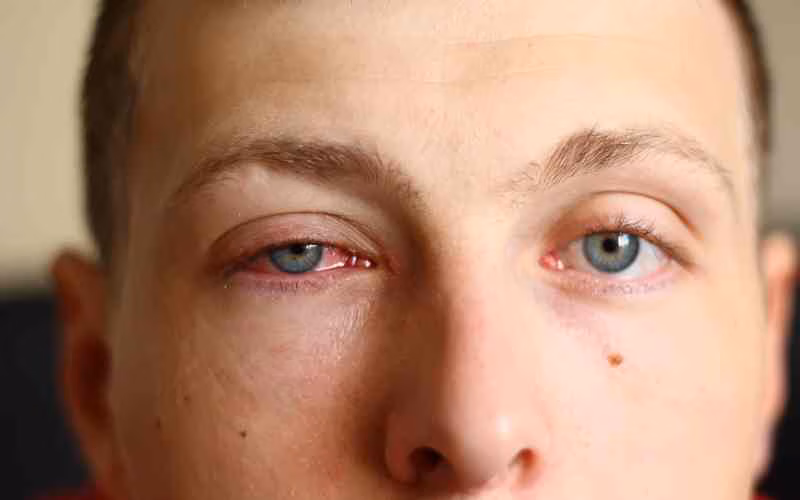 Những điều cần biết về bệnh đau mắt đỏ:  Nguyên nhân và  triệu  chứng lưu ý cần biết 